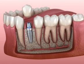 Dental Implants